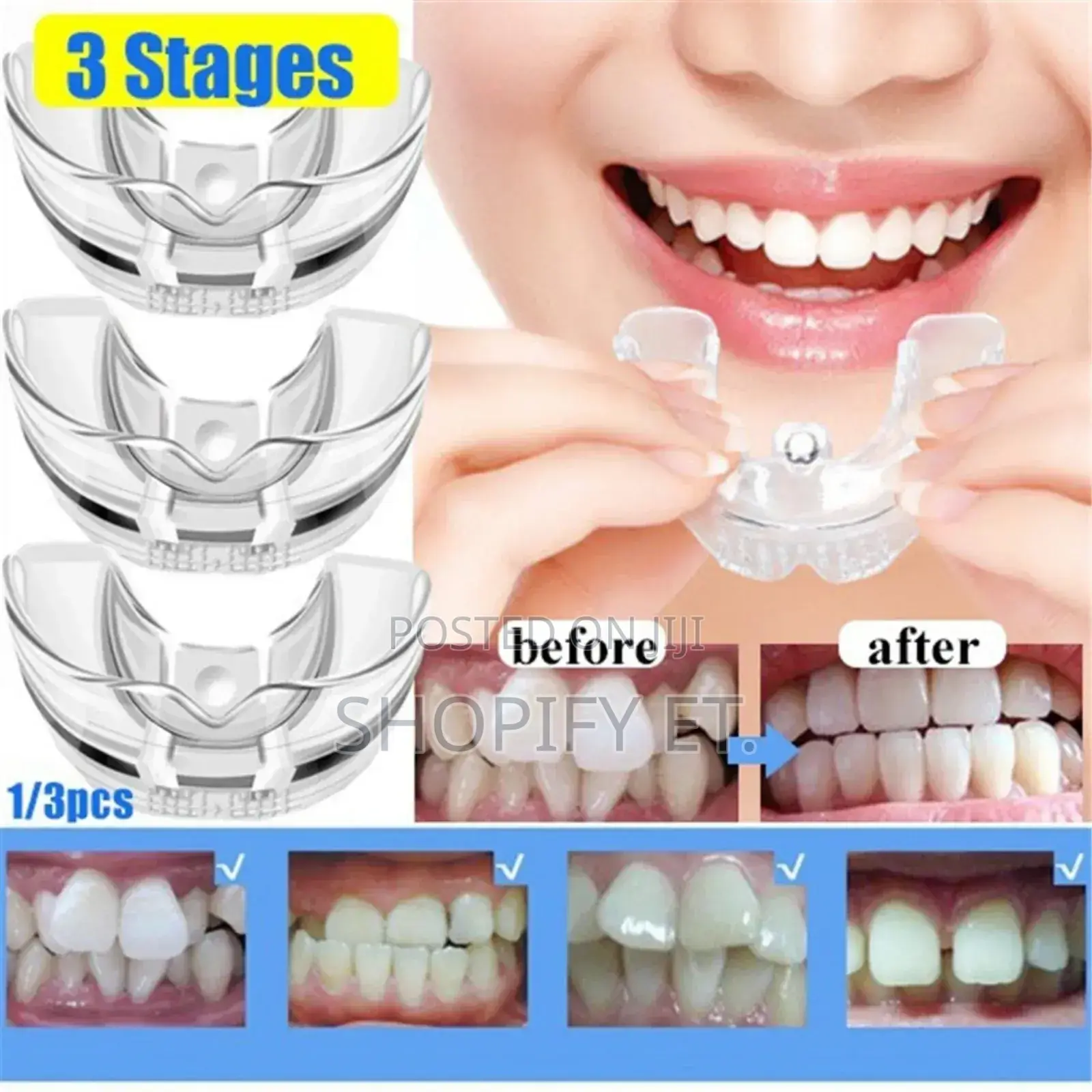 Teeth Alignment (በማይታመን ዋጋ)