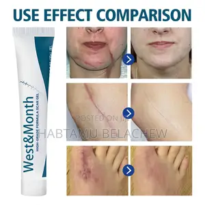Photo - Silicone Scar Gel