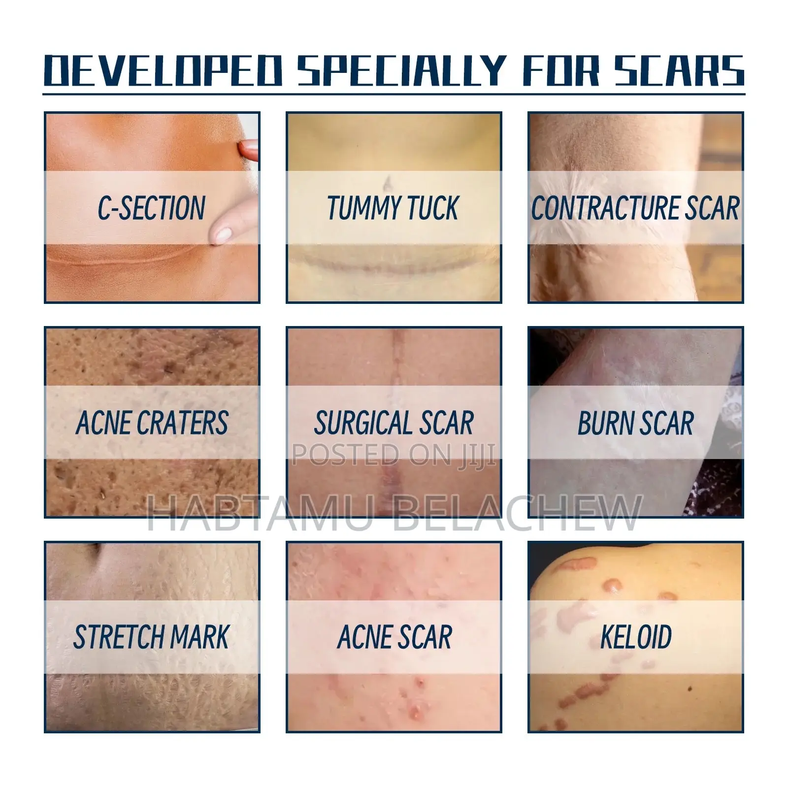 Silicone Scar Gel