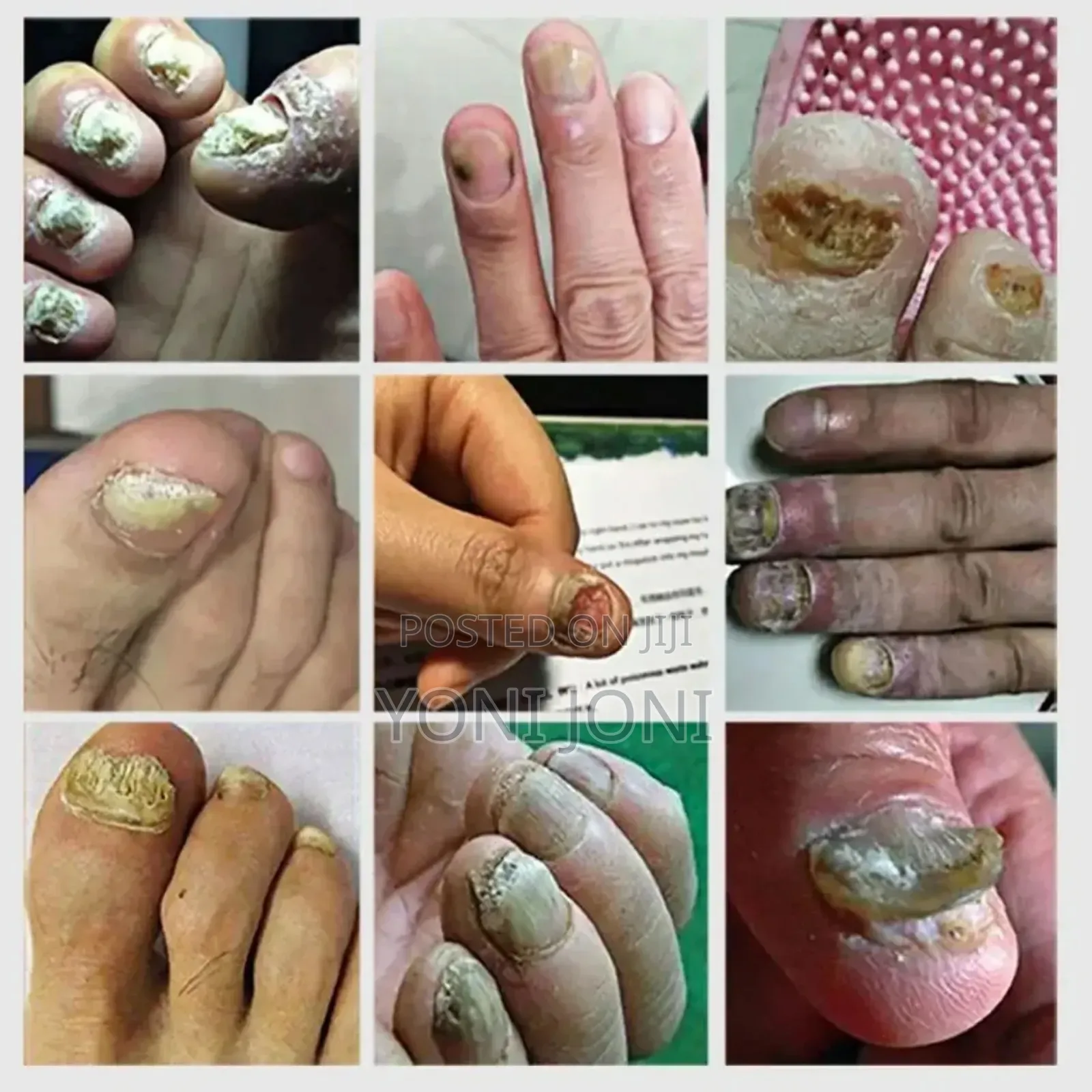 Nail Fungus Treatment ለ ጥፍረ መጥምጥ