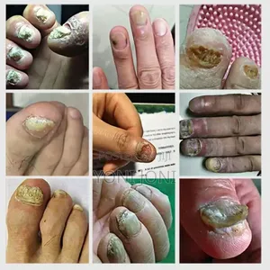 Nail Fungus Treatment ለ ጥፍረ መጥምጥ