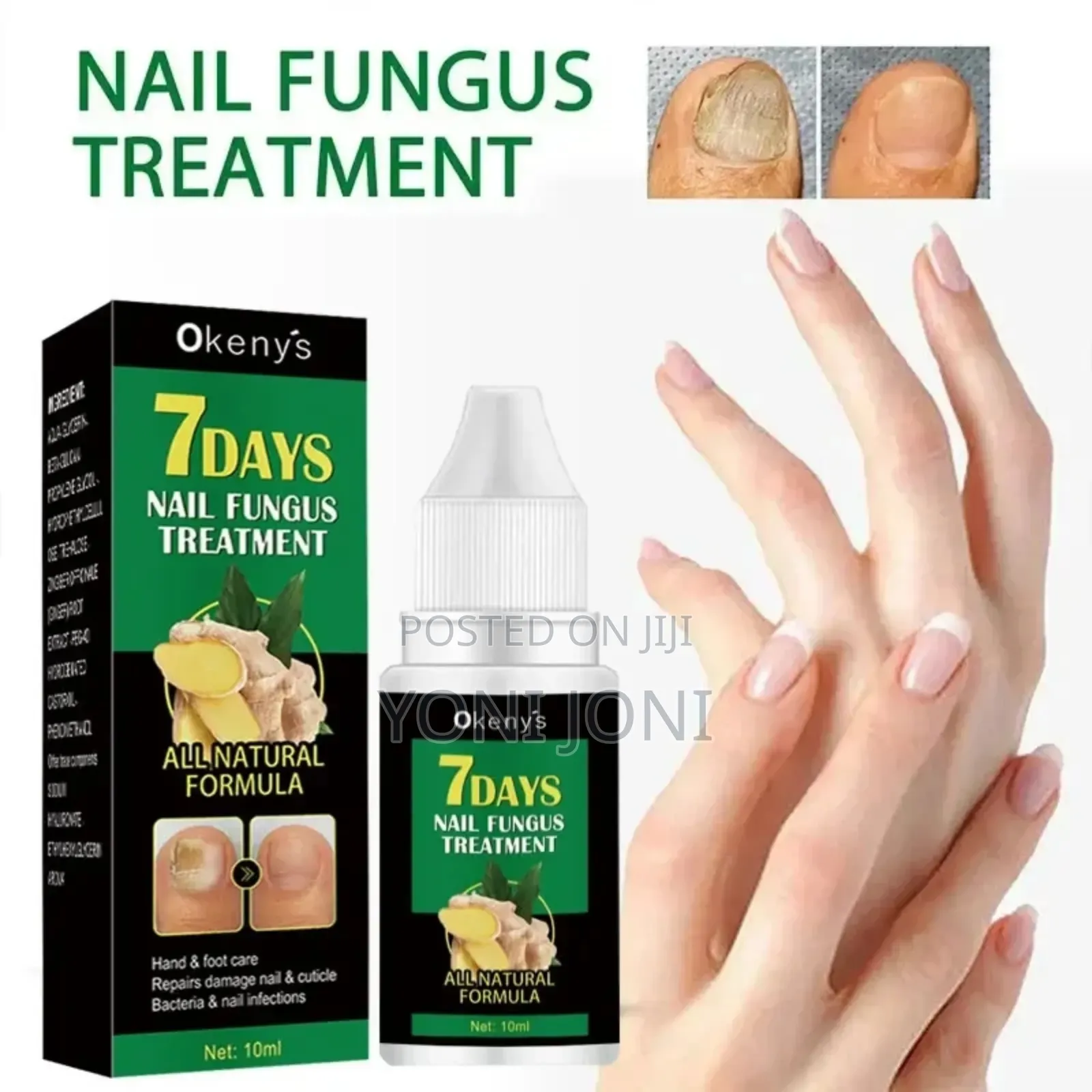 Nail Fungus Treatment ለ ጥፍረ መጥምጥ