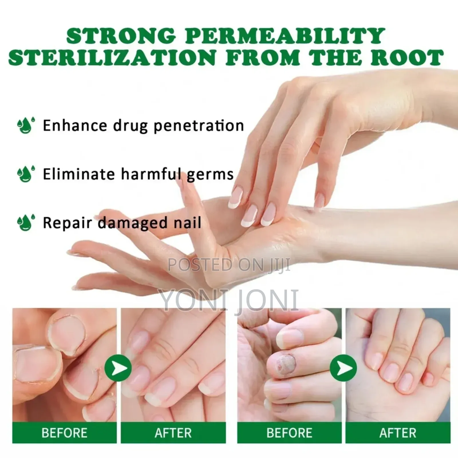 Nail Fungus Treatment ለ ጥፍረ መጥምጥ