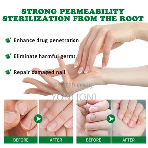 Nail Fungus Treatment ለ ጥፍረ መጥምጥ