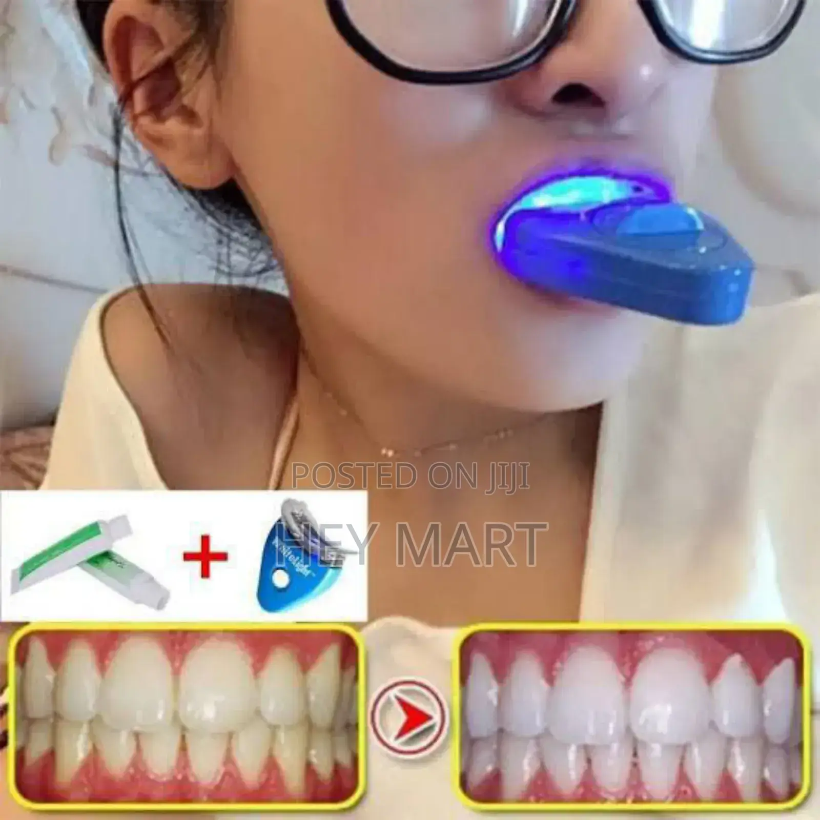 White Light Teeth Whitening