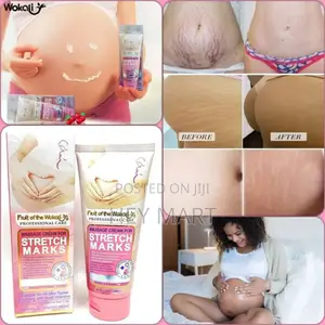 Photo - Stretch Mark Removal Cream