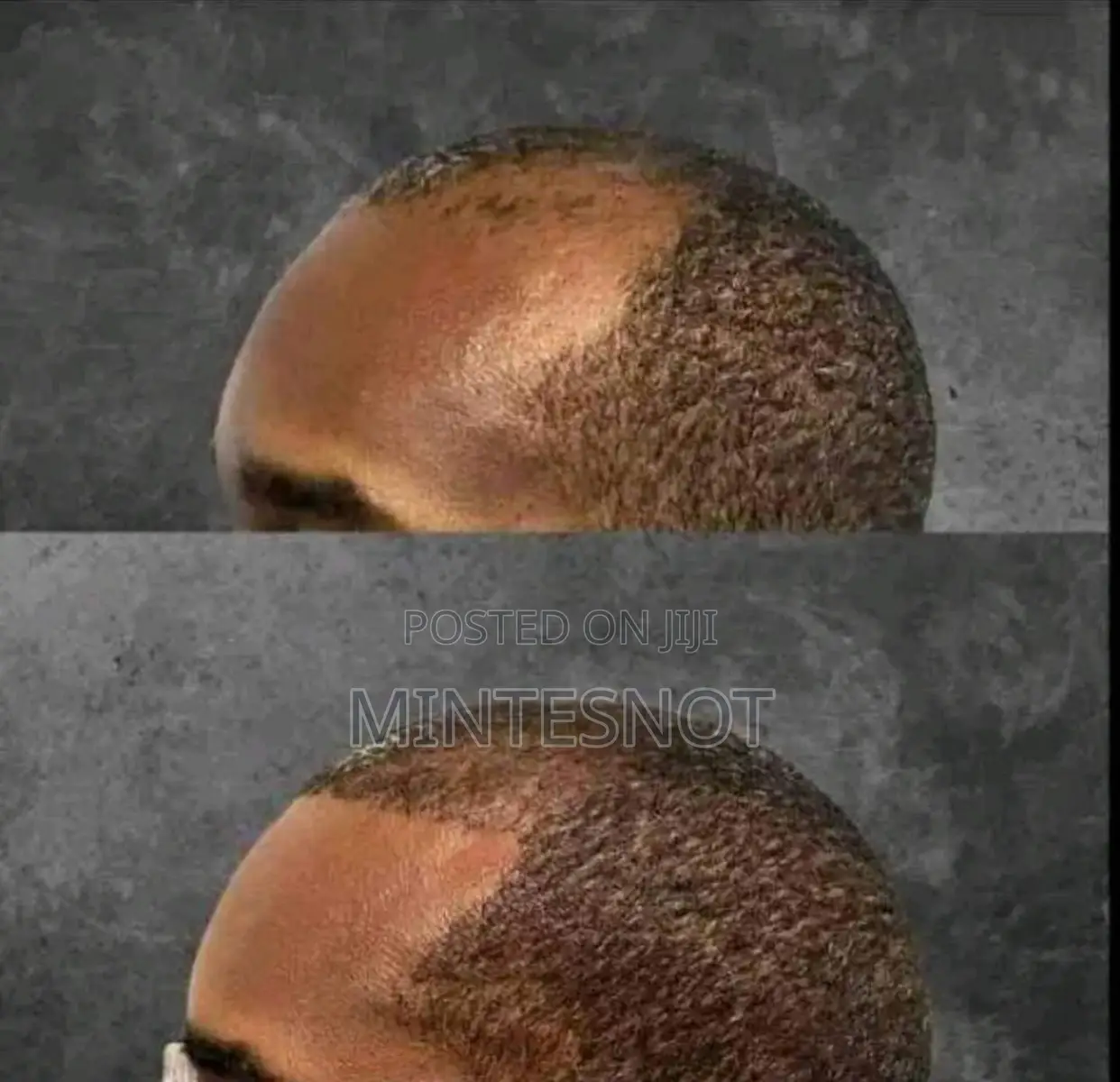 FEG Hair Growth Spray With 14 Days