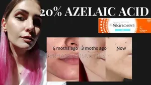Photo - Skinoren 20% Azelaic Acid