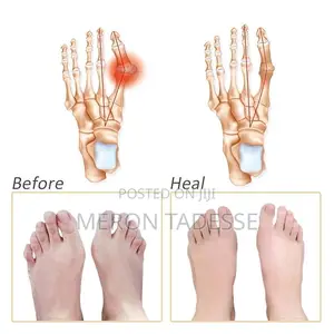 Photo - Want to Wear Your Favorite Shoes Without Pain? የሚያሳምማቹን ጫማ