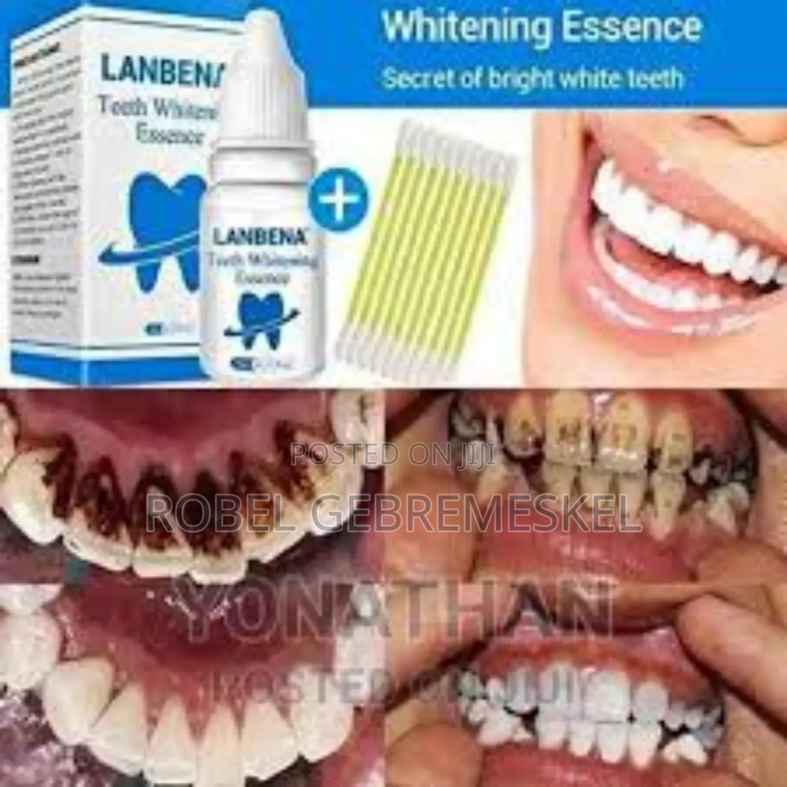 Lanbena Teeth Whitening