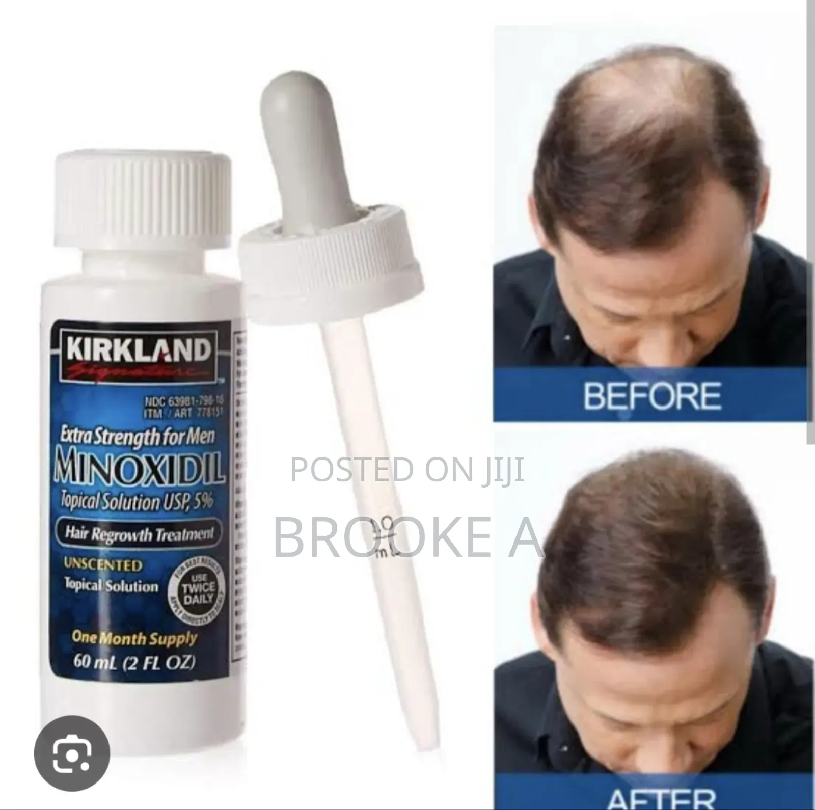 Minoxidil Hair Growth