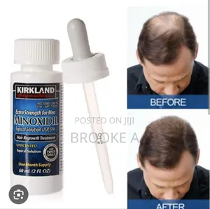 Minoxidil Hair Growth