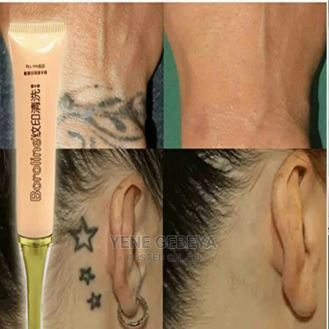 ማንኛውንም ንቅሳት ማጥፊያ