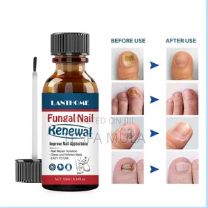 Photo - Renewal የተበላሸ ጥፍር ያስተካክላል