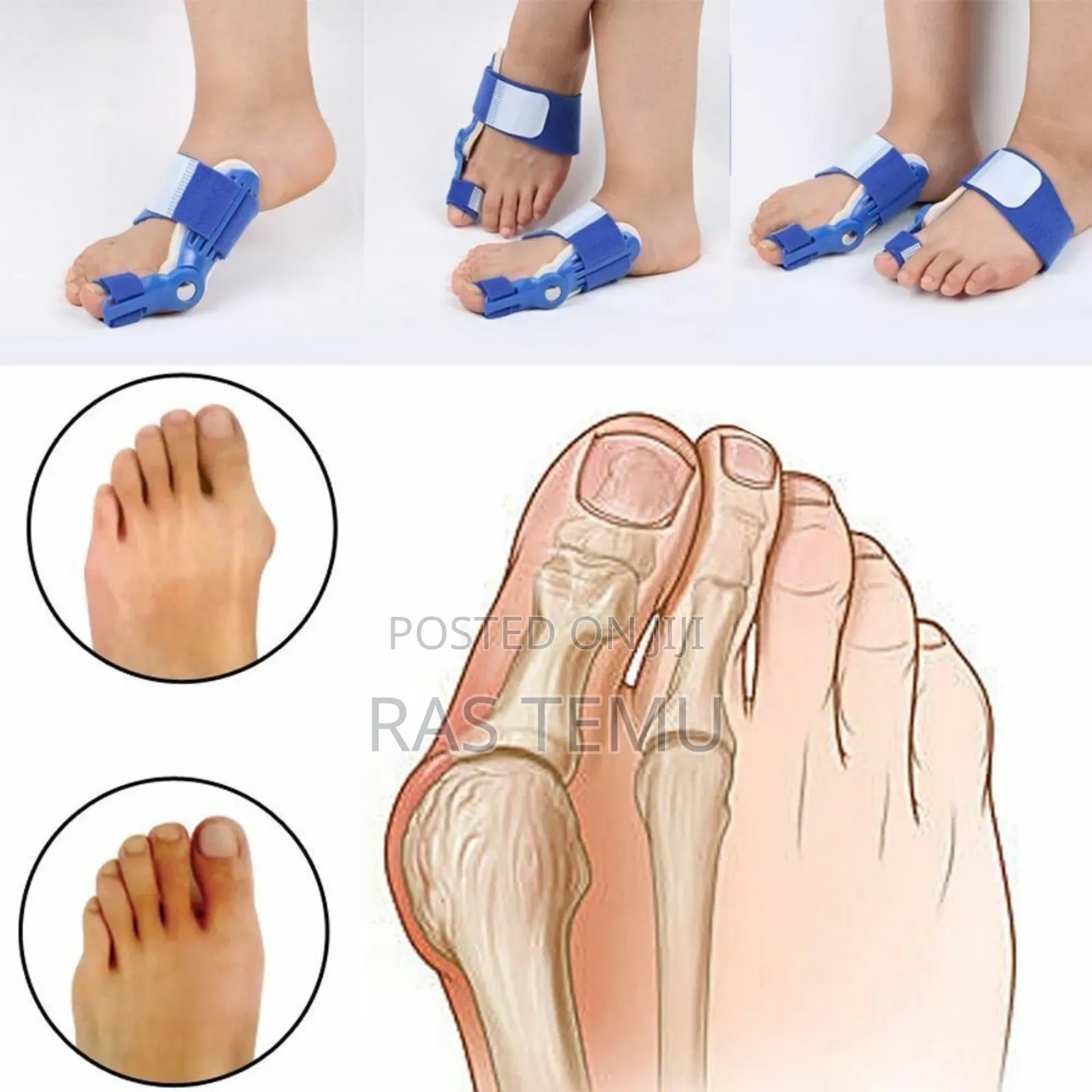 Bunion Corrector