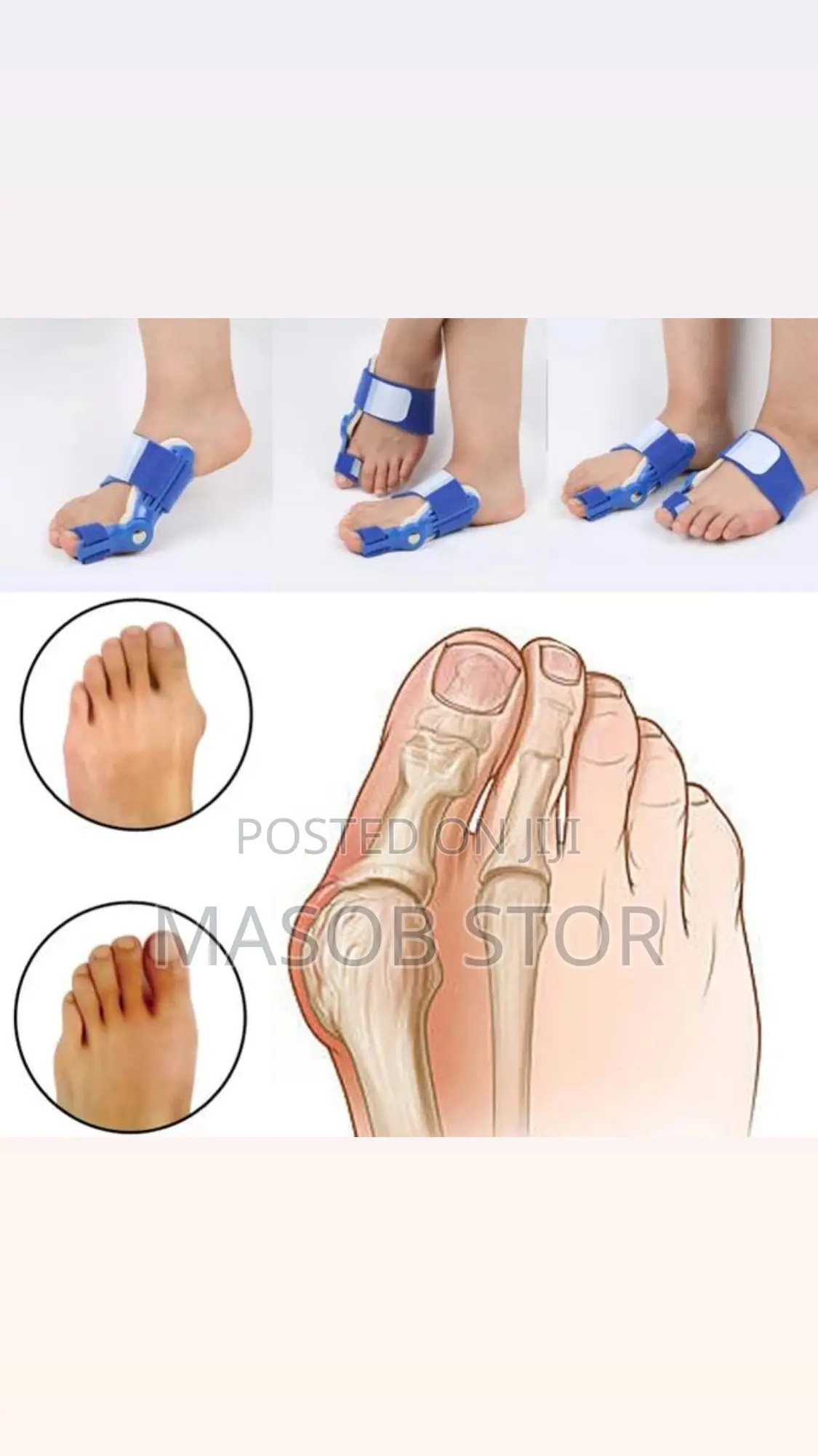 የአውራ ጣት ማስተካከያ / Bunion Corrector