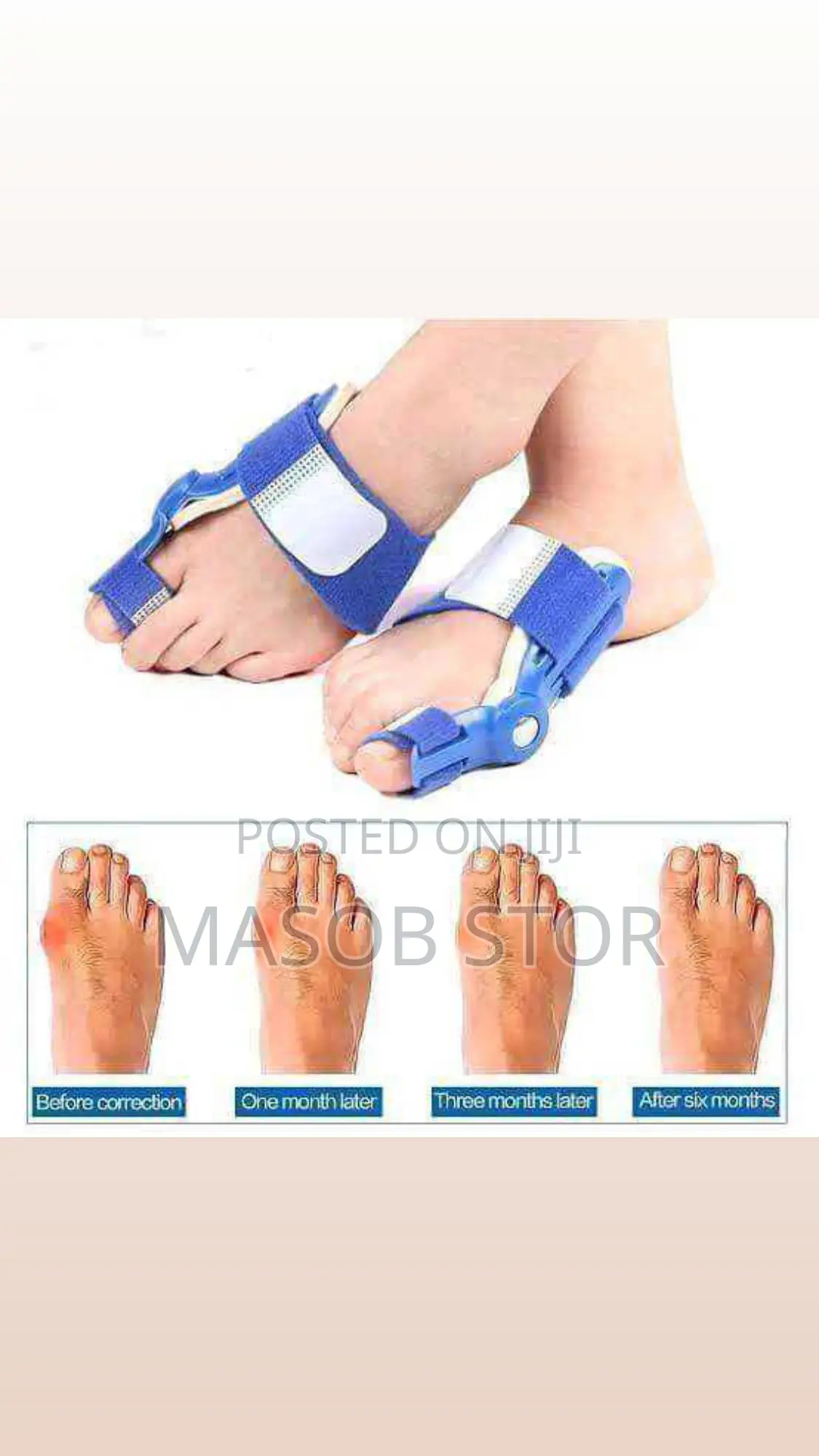 የአውራ ጣት ማስተካከያ / Bunion Corrector