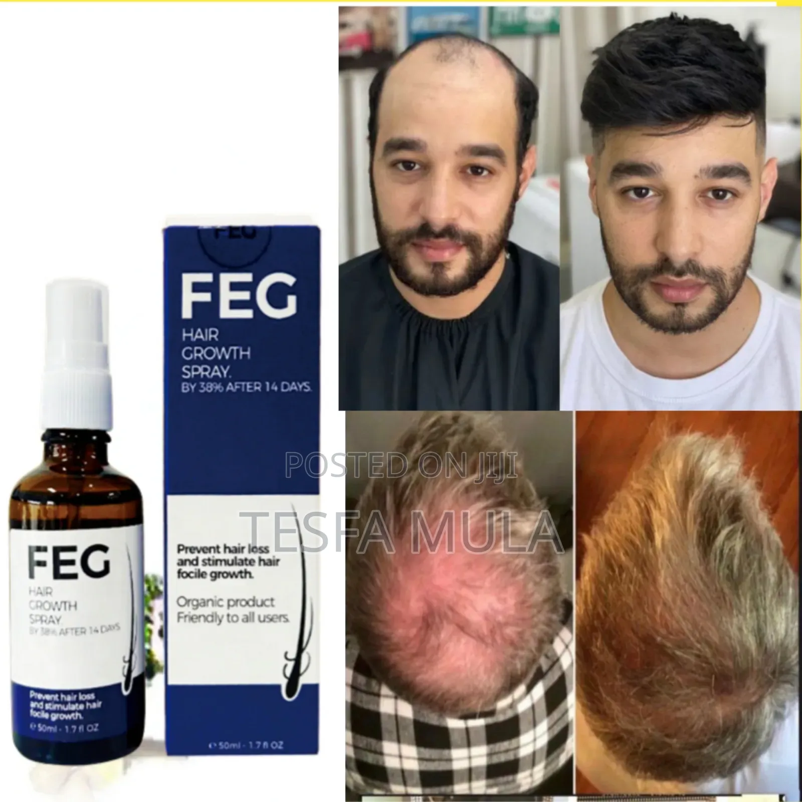 Feg የተመለጠ ፀጉር ያሳድጋል