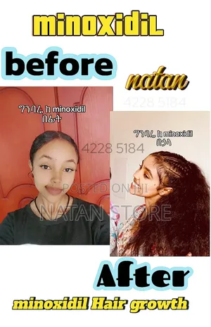 Hairgrow Minoxidil Spray Available