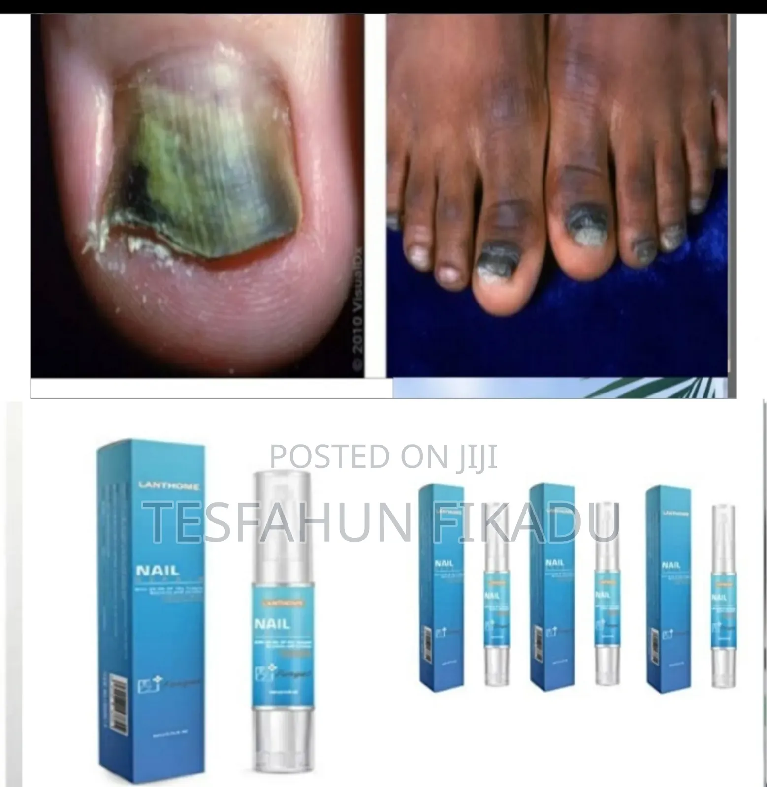 የጥፍር ችግርዎን ሙሉ ለሙሉ የሚያስተካክል