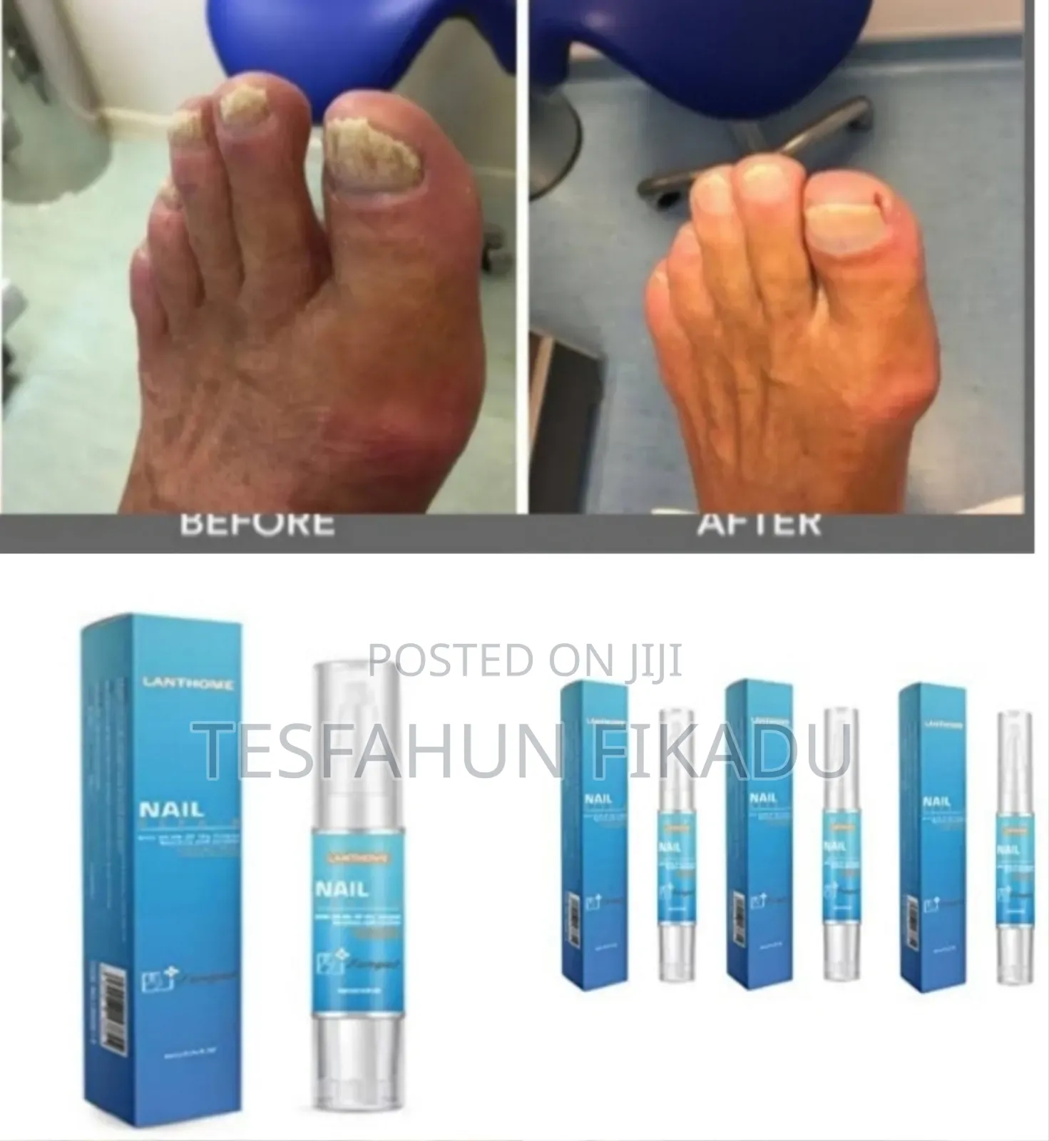 የጥፍር ችግርዎን ሙሉ ለሙሉ የሚያስተካክል