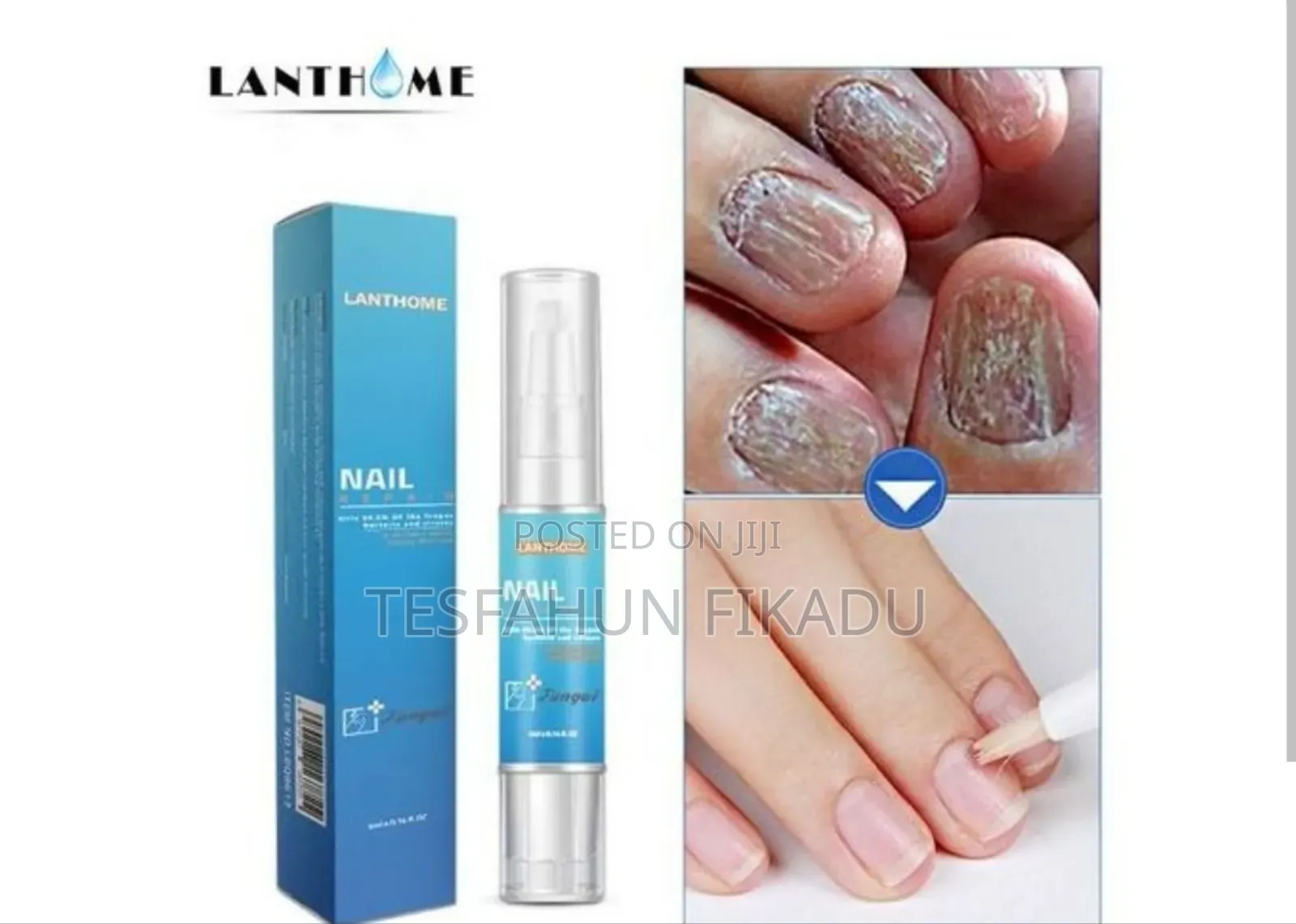 የጥፍር ችግርዎን ሙሉ ለሙሉ የሚያስተካክል