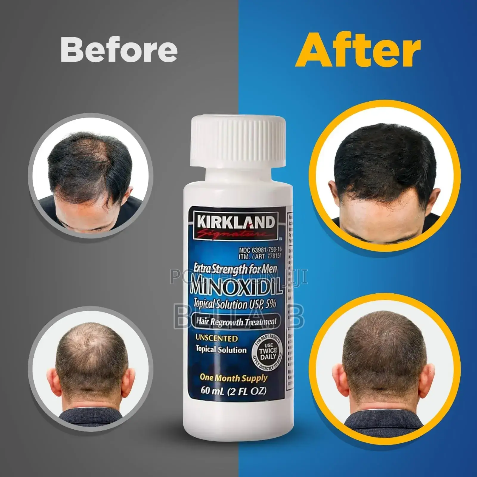 Minoxidil Gentle and Safe