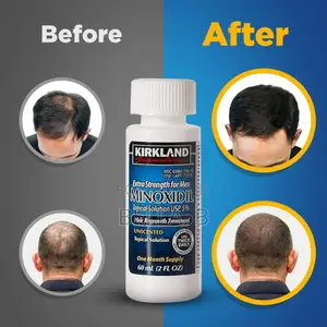 Photo - Minoxidil Gentle and Safe