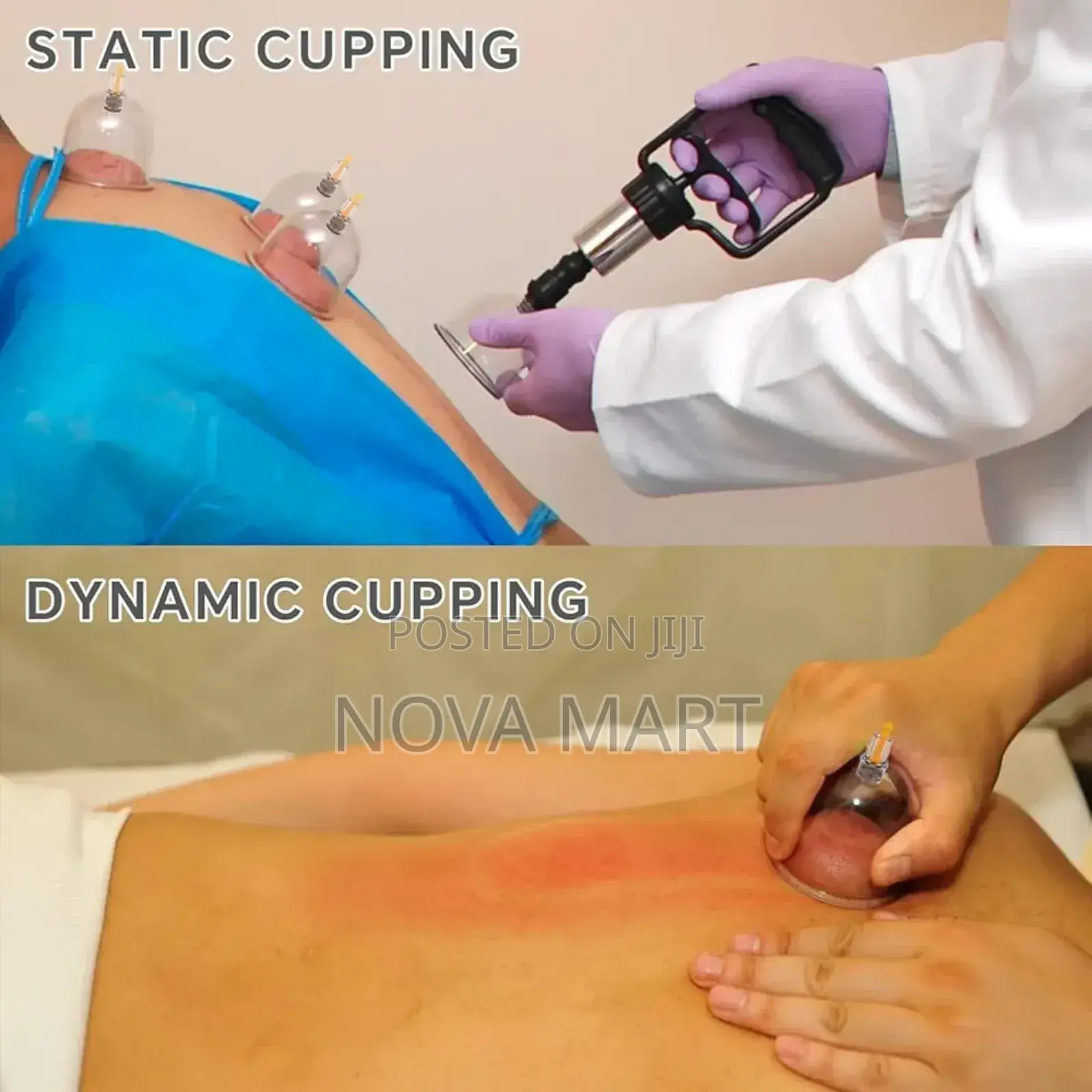 Suction Cupping