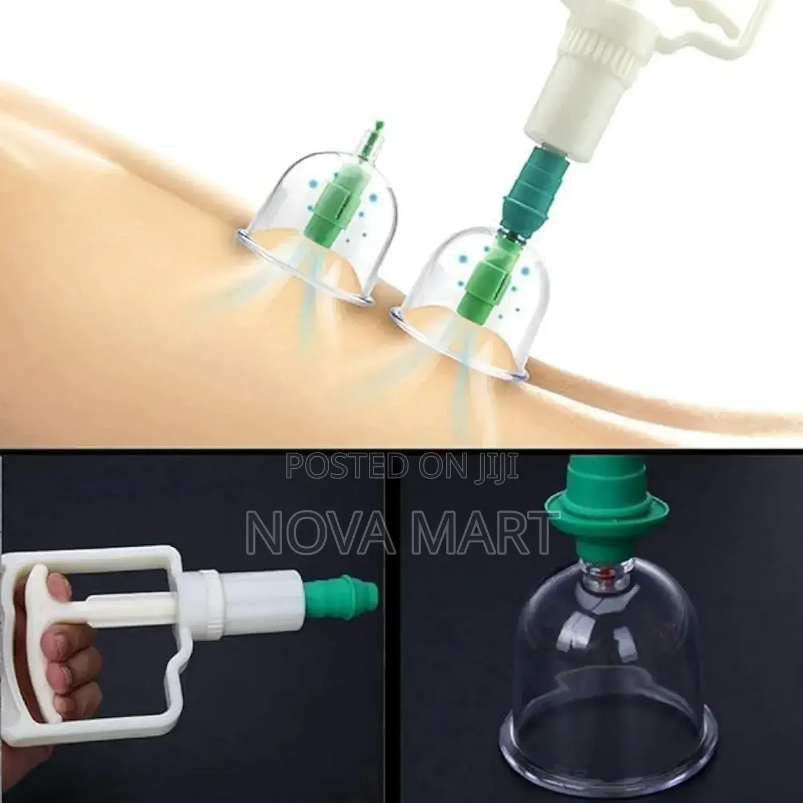 Suction Cupping