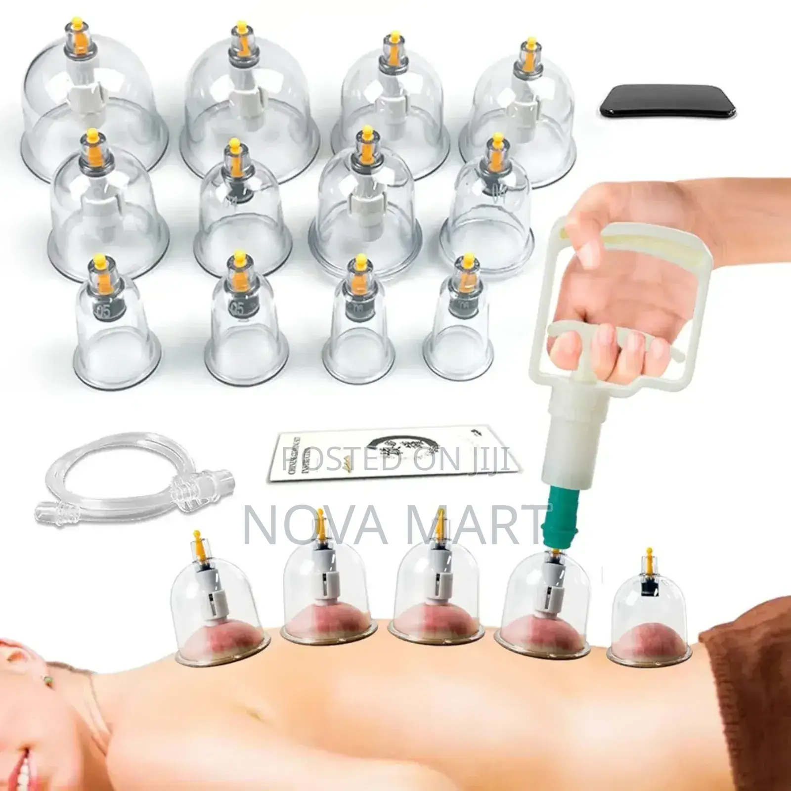 Suction Cupping
