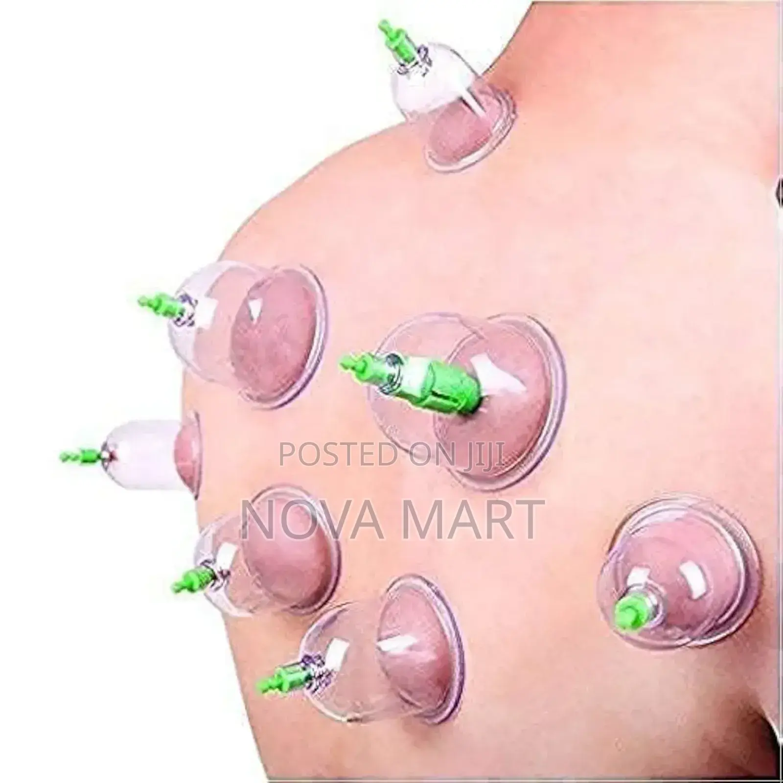 Suction Cupping