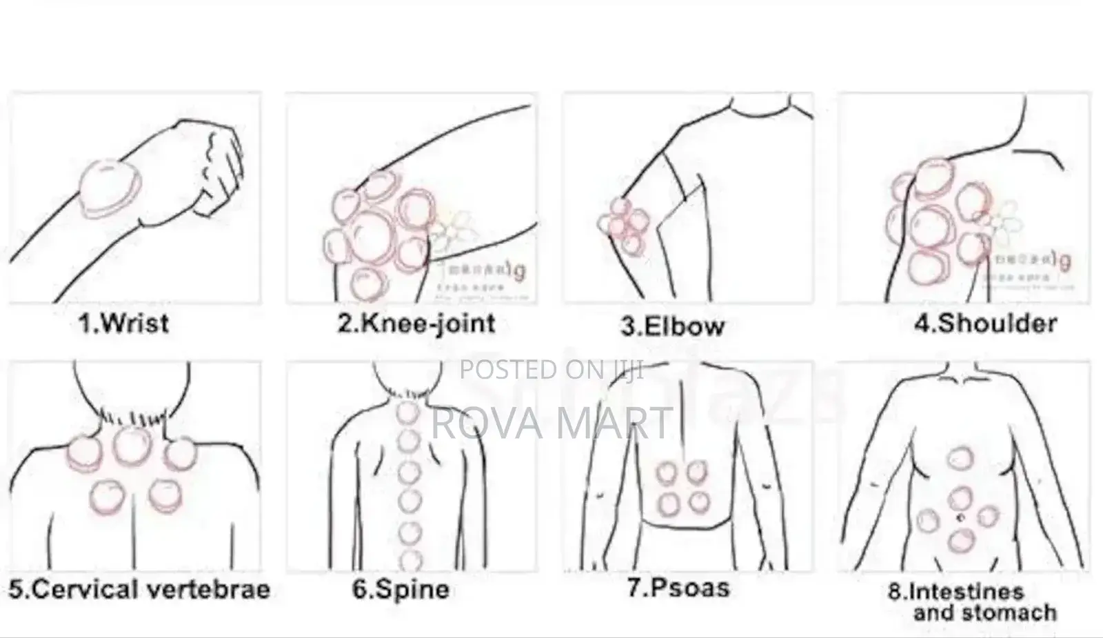 Suction Cupping