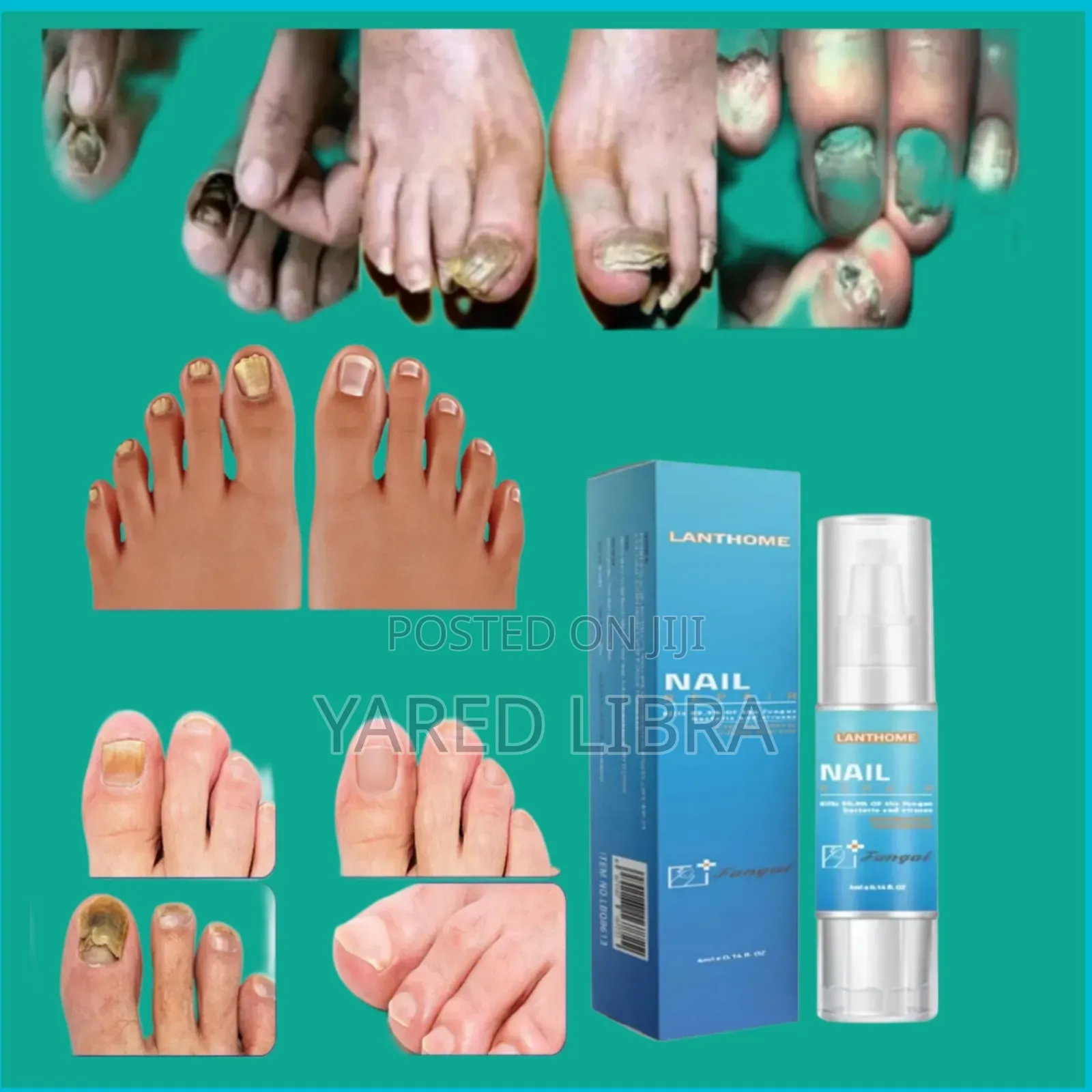 Nail በፈንገስ የተጎዳ ጥፍር ይመልሳል