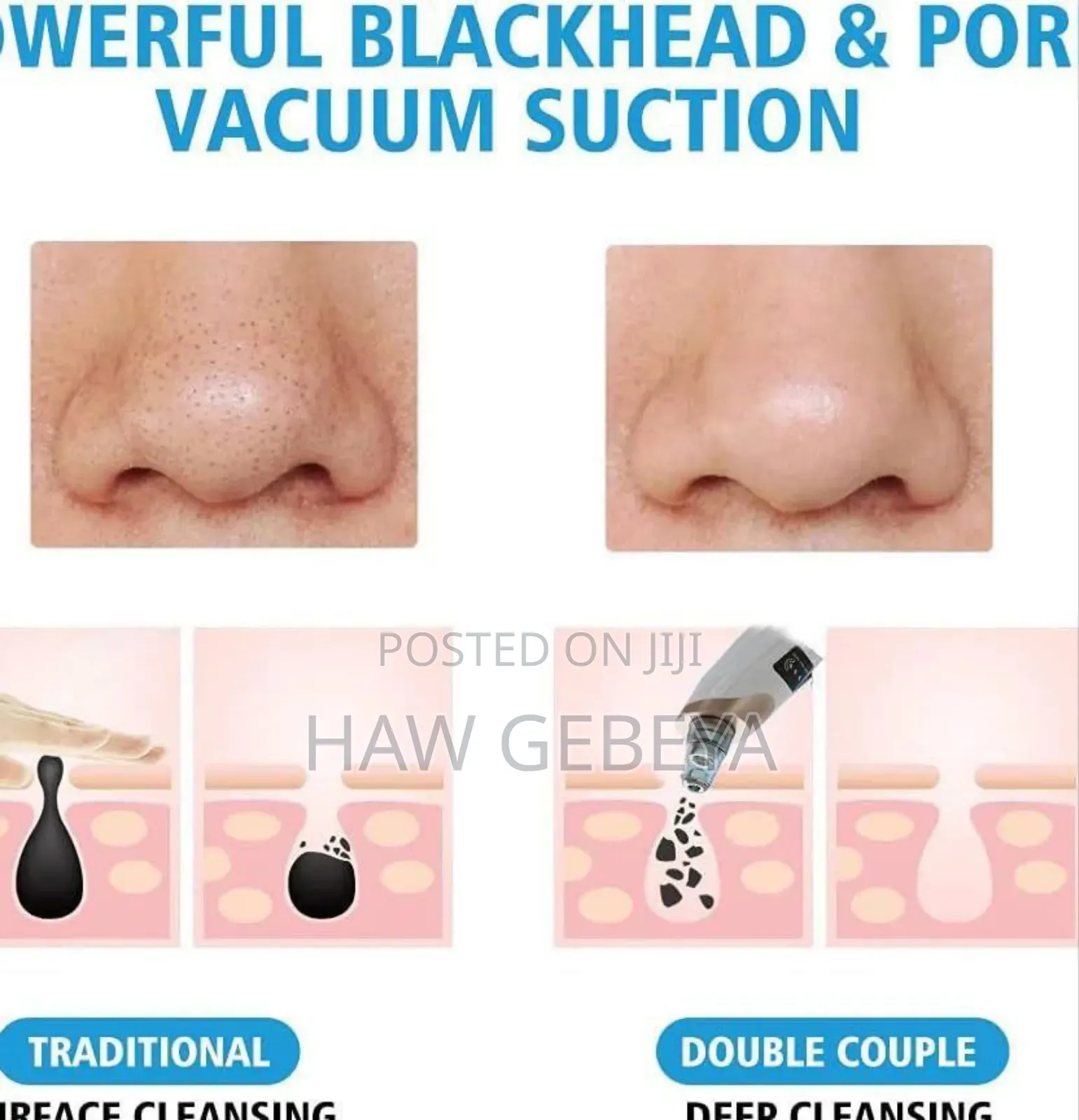 Multifunctional Blackhead Remover