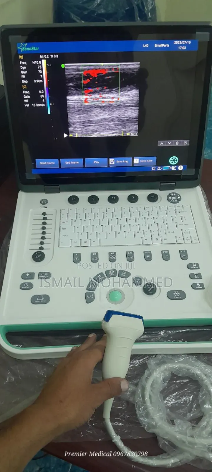 Color Doppler Ultrasound