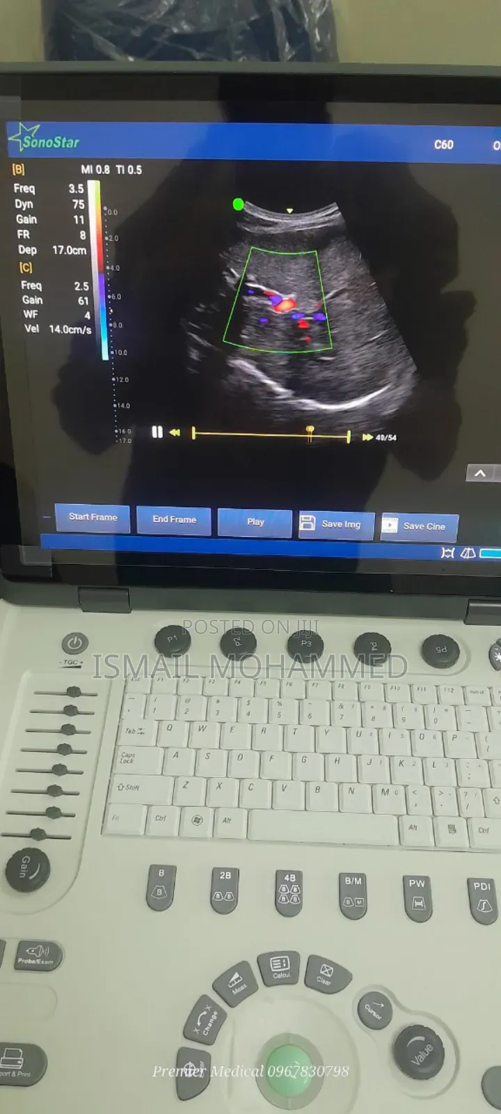 Color Doppler Ultrasound