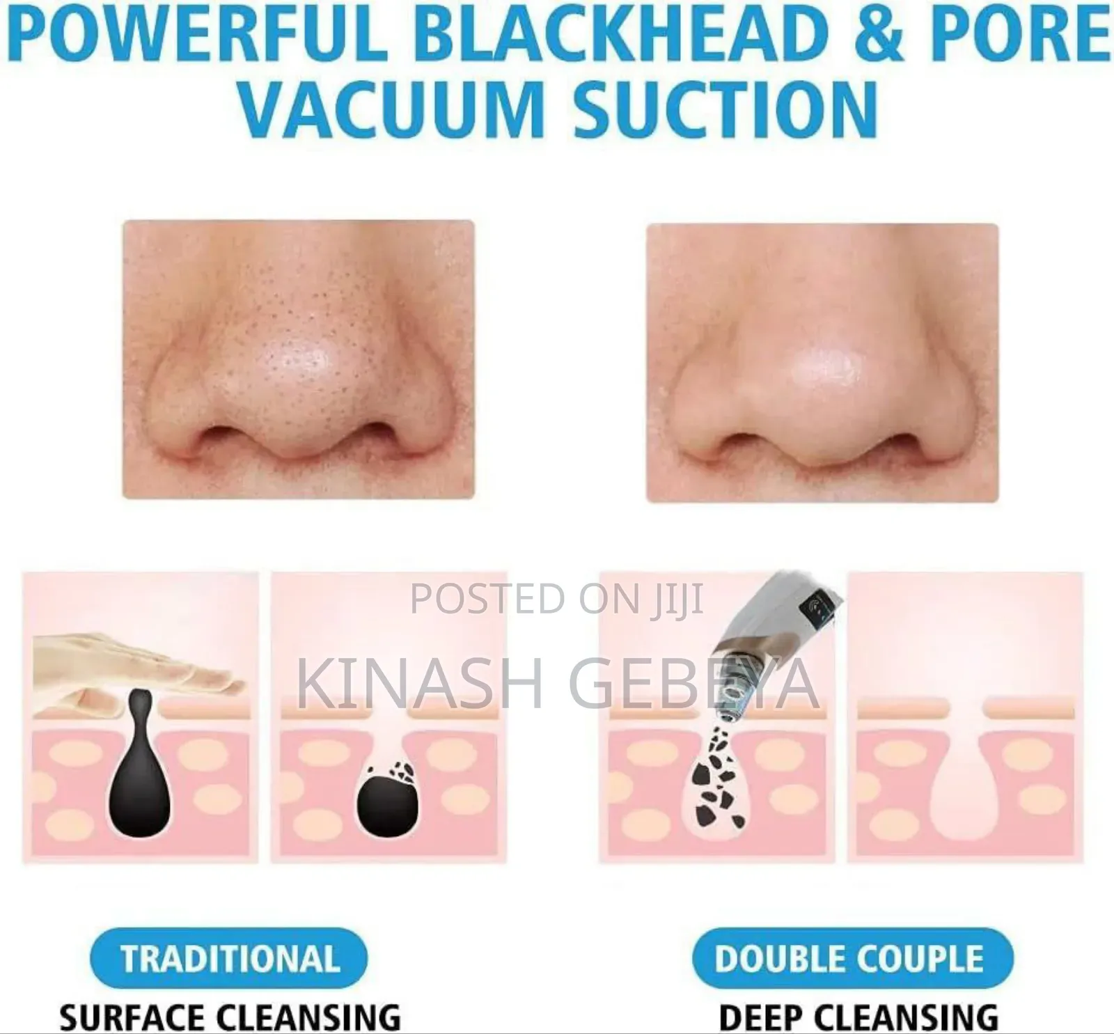 Multifunctional Black Head Remover(የፊት ቆዳ ማፅጃ)