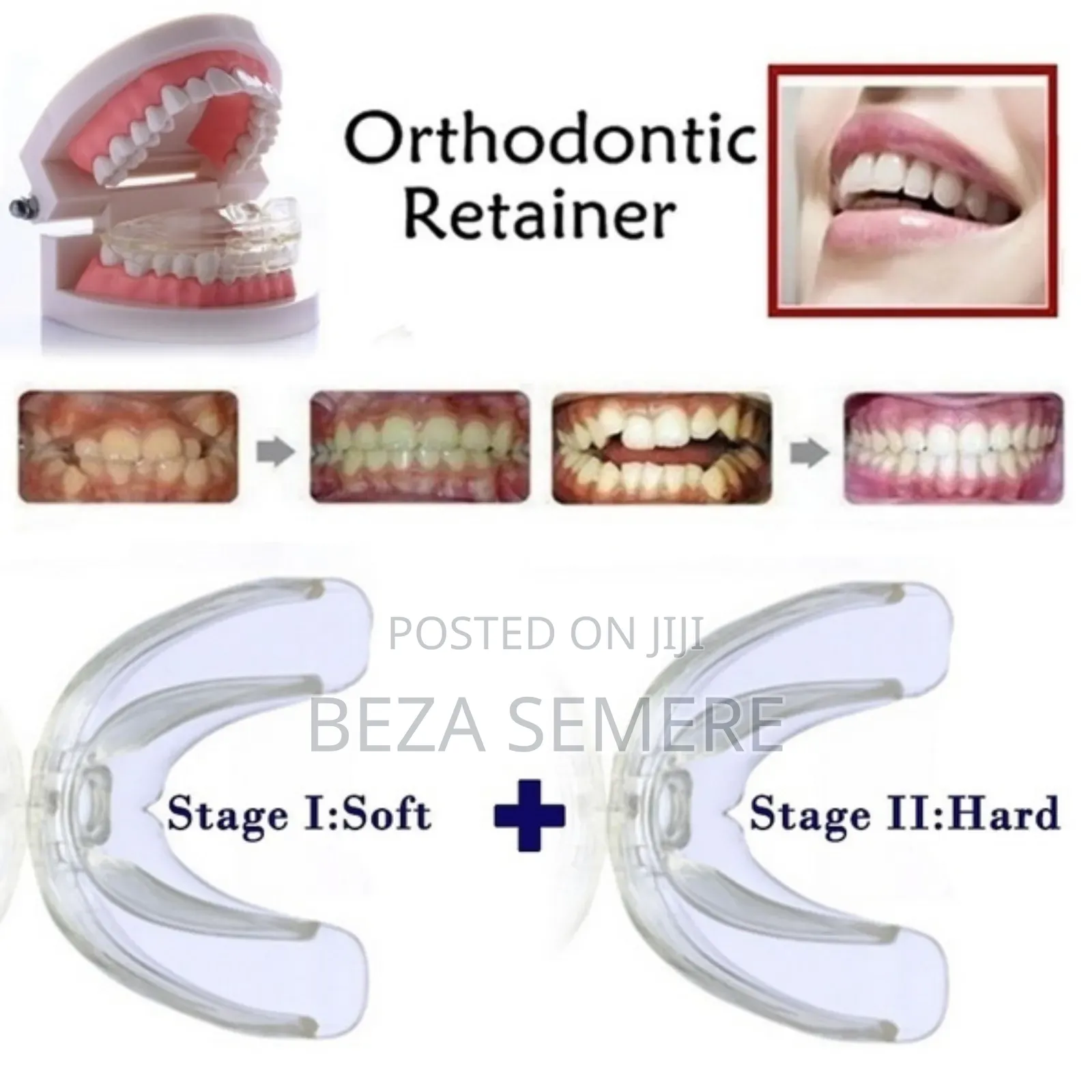 Teeth Alignment Brace
