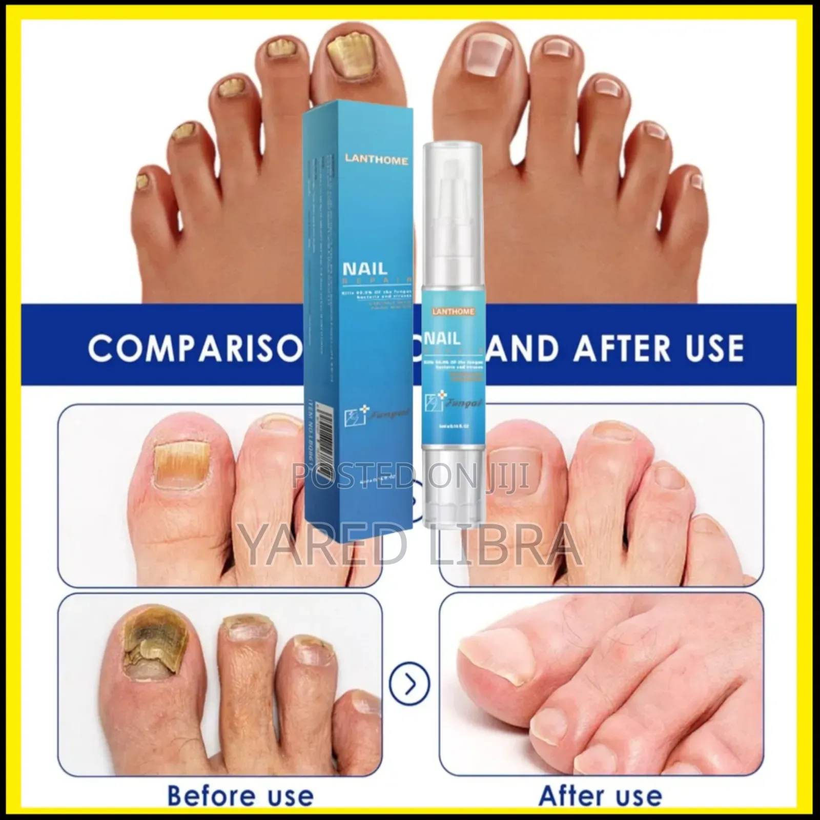 Lanthom በፈንገስ የተበላሸ ጥፍር ያስተካክላል