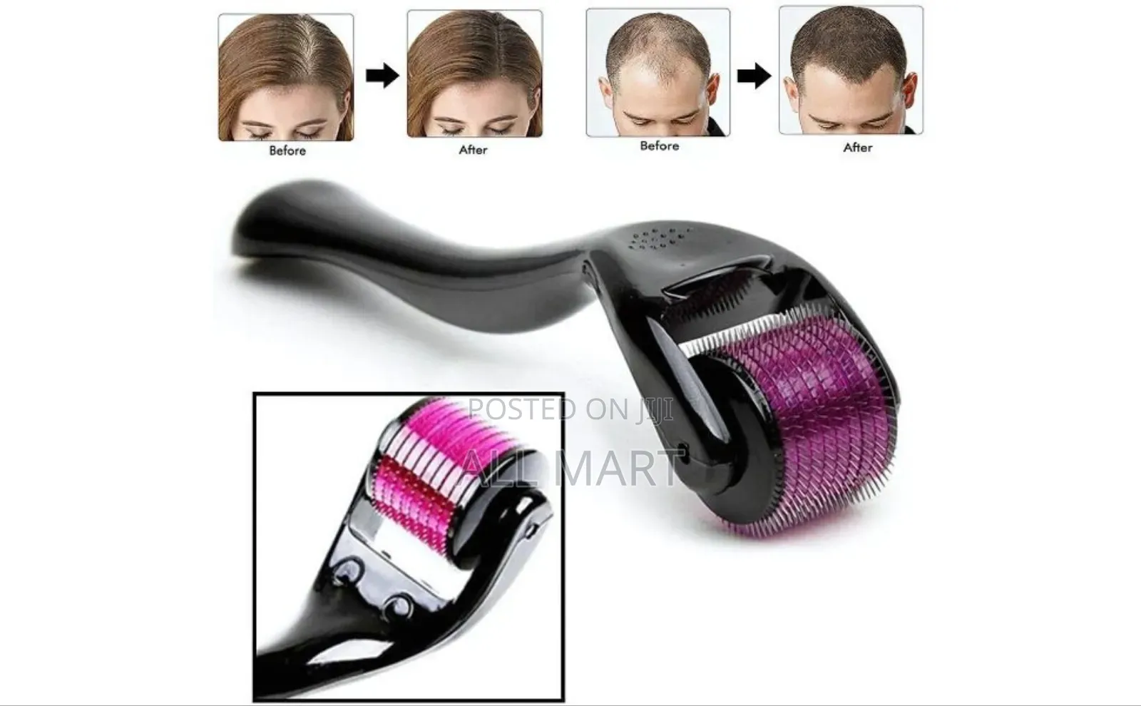 Derma Roller System 0.5mm With 540 Micro Needles