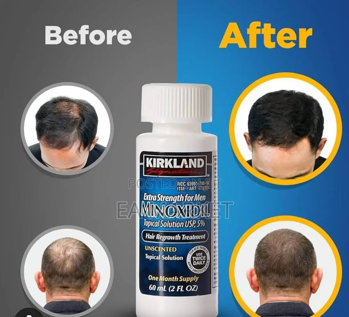 Minoxidil Usa