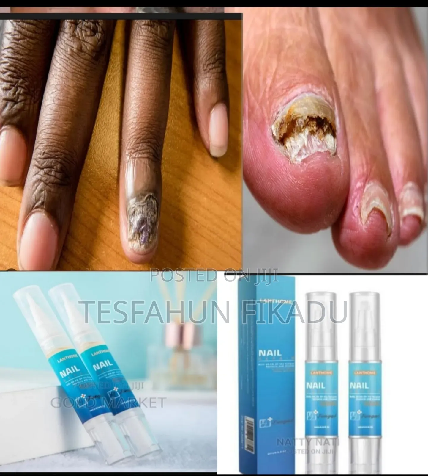 ጥፍሬ በለዘ ተነቀለ እያሉ እንዳይጨነቁ!