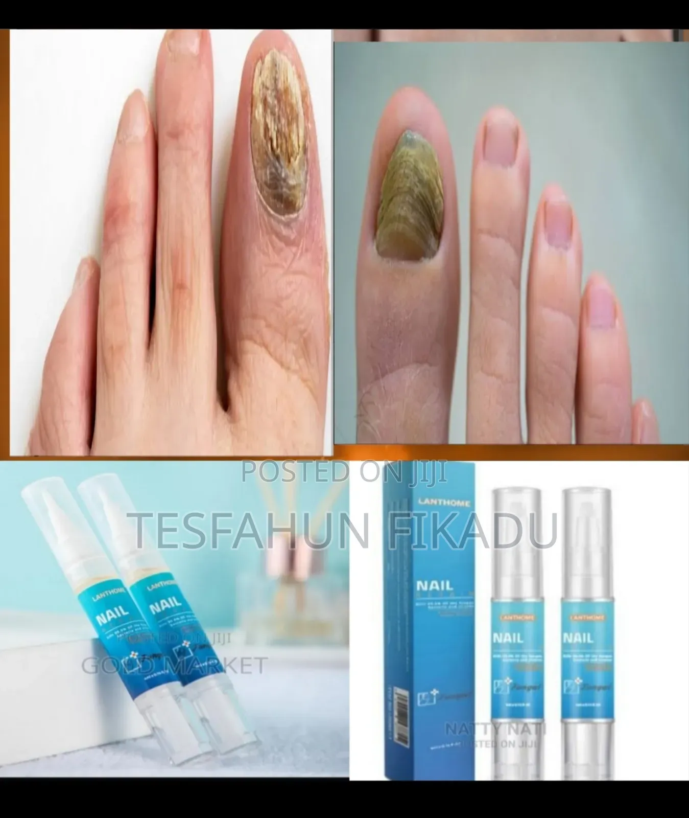 ጥፍሬ በለዘ ተነቀለ እያሉ እንዳይጨነቁ!