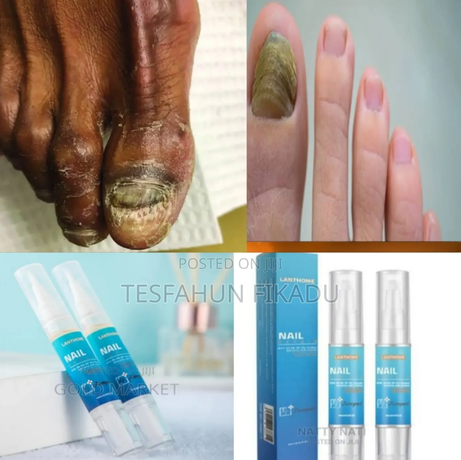 ጥፍሬ በለዘ ተነቀለ እያሉ እንዳይጨነቁ!