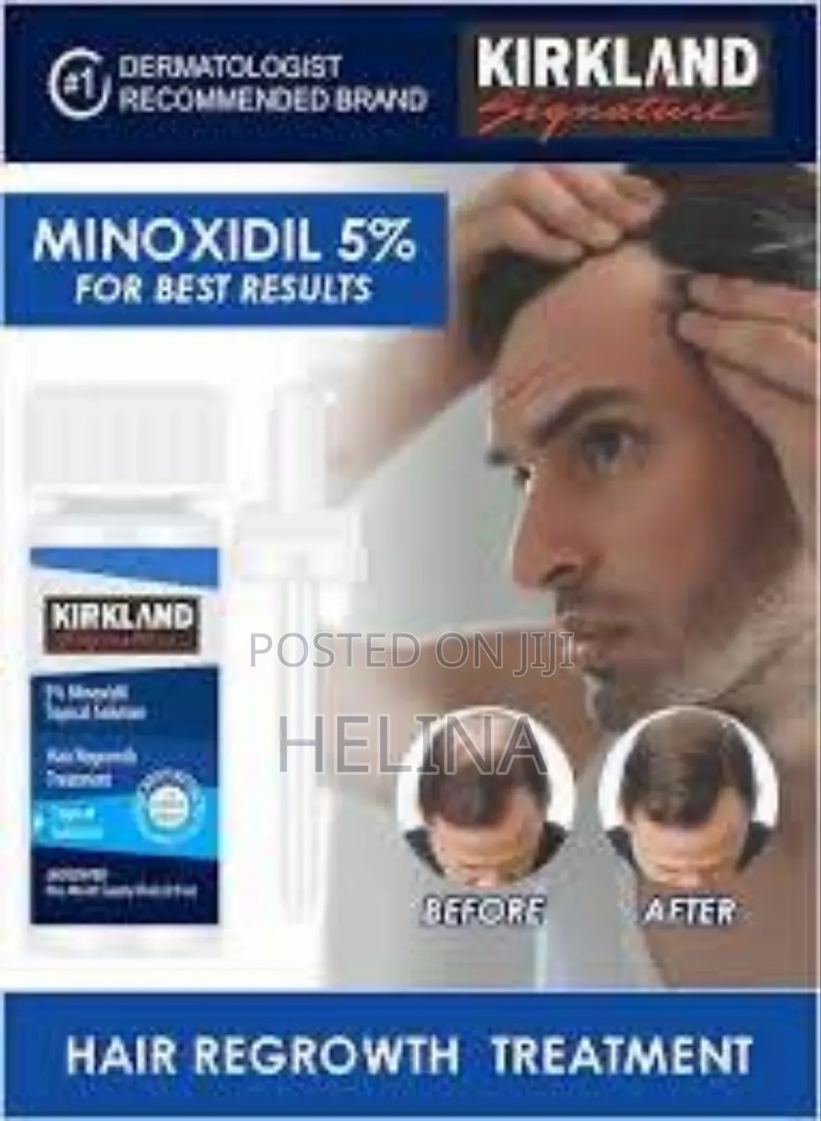 Kirkland Minoxidil 5% for Best Results From Usa