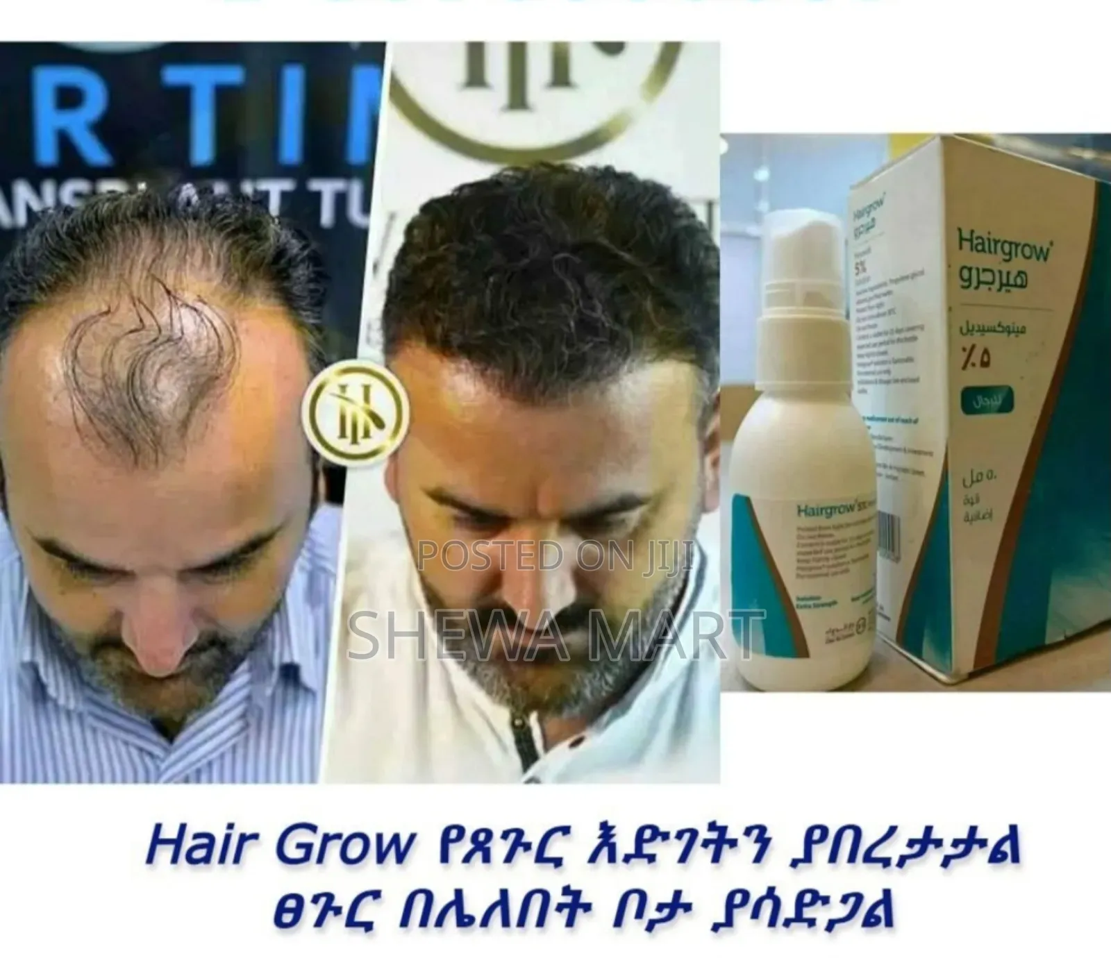 Hair Grow የጸጉር እድገትን ያበረታታል
የፀጉር መርገፍ ችግር ላለባቸው ሰዎች አዲስ የፀጉር እድገትን ለማ