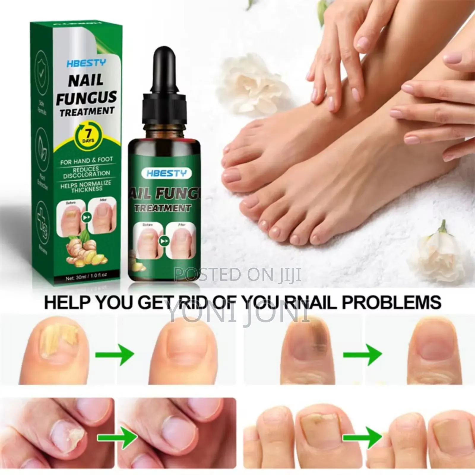 Nail Fungus Treatment Thicker Nail