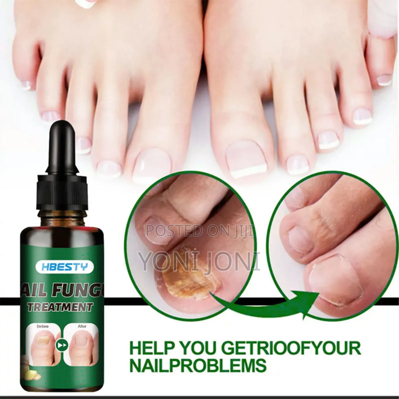 Nail Fungus Treatment Thicker Nail