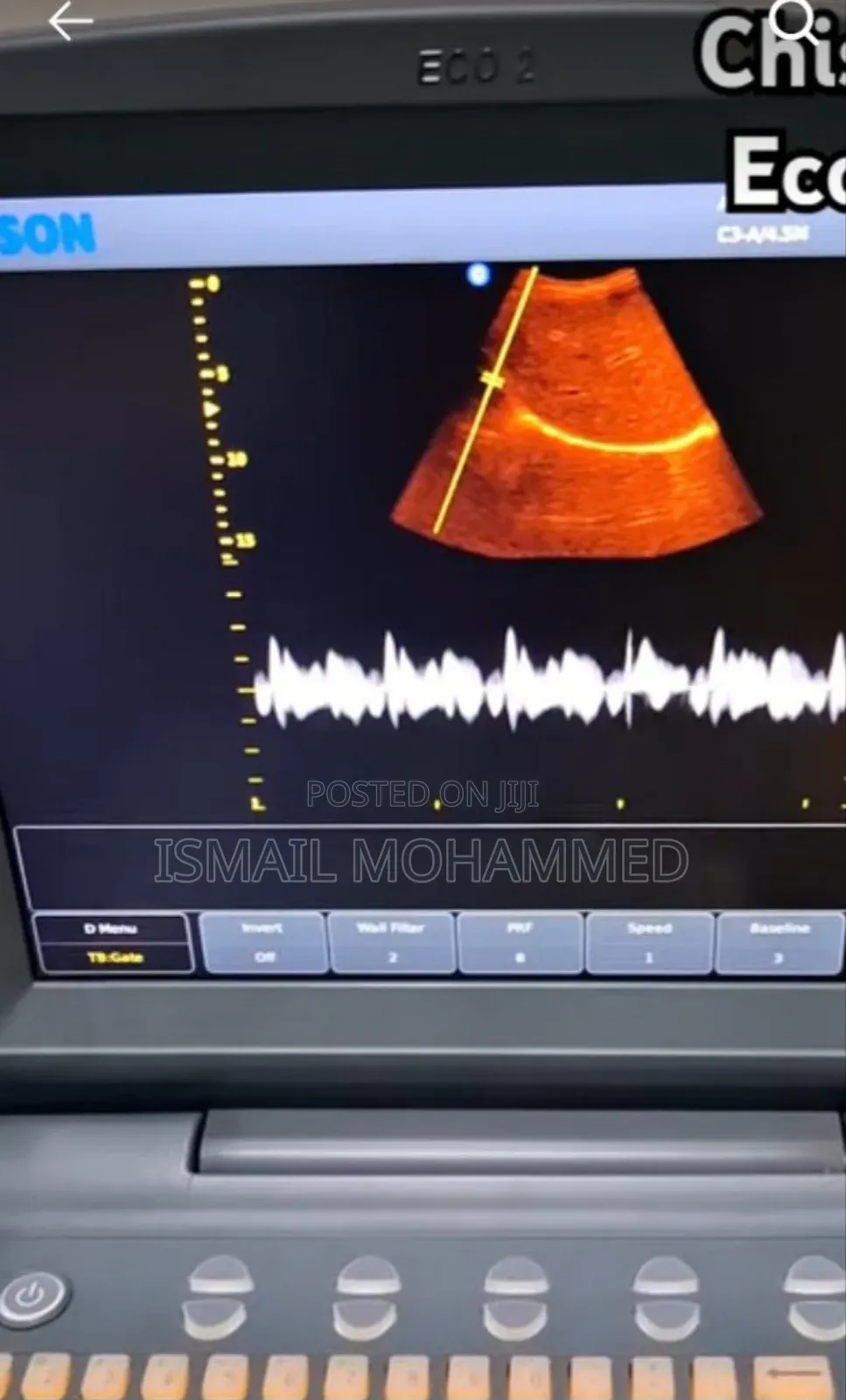 Chison Ultrasound Machine